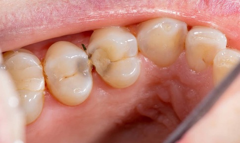 Những dấu hiệu cảnh báo cơ thể thiếu canxi người Việt dễ bỏ qua