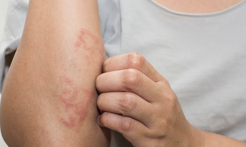 Cách giúp giảm tình trạng mụn nước, ngứa ngáy khó chịu mùa hè