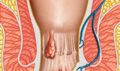 6 thói quen dễ gây bệnh trĩ mà nhiều người mắc phải