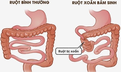 Đau bụng cảnh giác với xoắn ruột cần nhập viện khẩn cấp