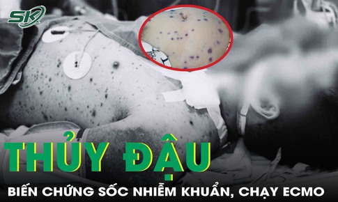 Biến chứng thủy đậu: Một ca xin về vì sốc kháng trị, một ca phải lọc máu, chạy ECMO