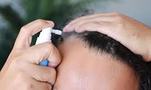 Thuốc điều trị rụng tóc tại chỗ có thể gây rối loạn cương dương, lo âu và sương mù não