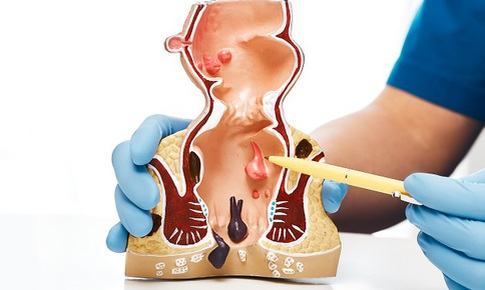 Bệnh trĩ nội có mấy cấp độ?