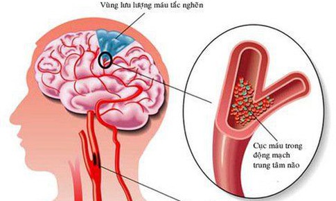 Câu hỏi thường gặp về bệnh xơ vữa động mạch não