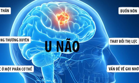 Làm thế nào để biết mình bị u não?