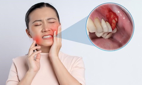 Nhiễm trùng Implant nguyên nhân do đâu? Dấu hiệu và cách khắc phục