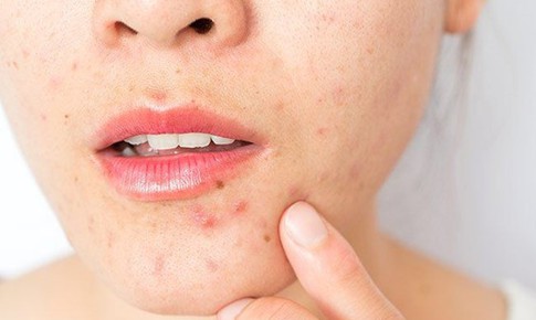 Mụn trứng cá có tự chữa được không?