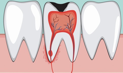 Viêm tủy răng ở trẻ có biểu hiện gì, hệ lụy ra sao?