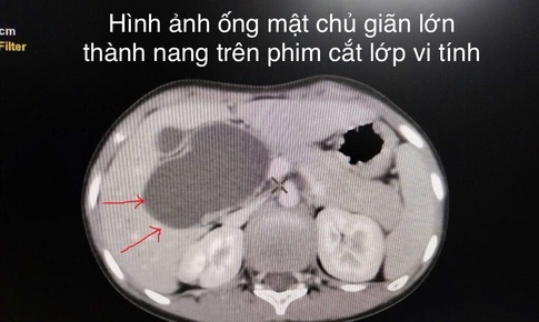 Bệnh viện Trẻ em Hải Phòng nội soi cắt nang ống mật chủ lớn cho bệnh nhi 10 tuổi