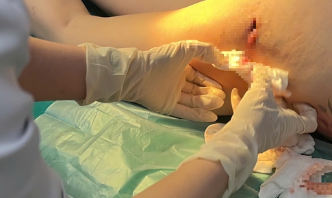Chi gần 100 triệu nâng mông, người phụ nữ nhận 'trái đắng' với ổ viêm mủ gây đau đớn