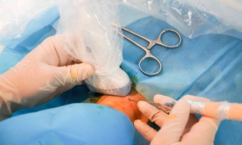 Đốt sóng cao tần điều trị u tuyến giáp lành tính không cần phẫu thuật