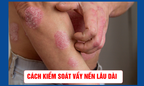 Kiểm soát vẩy nến lâu dài – Đừng chỉ lo xử lý triệu chứng mà quên mất gốc bệnh