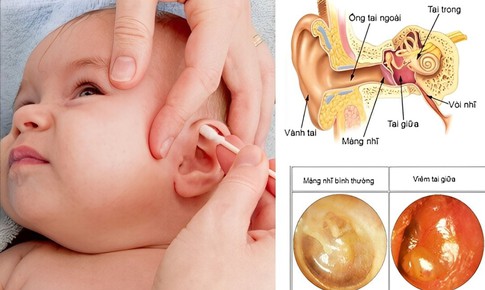 Trẻ dưới 2 tuổi bị vi&#234;m tai giữa cấp mủ: Cha mẹ cần l&#224;m g&#236; để cải thiện nhanh triệu chứng?