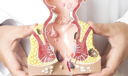 Cách để hạn chế bệnh trĩ phát triển