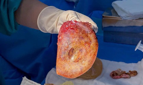 Điều trị co thắt bao xơ sau nâng ngực