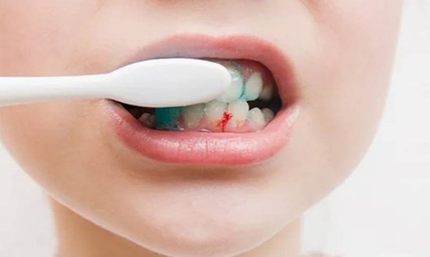 Chảy máu chân răng do đâu?