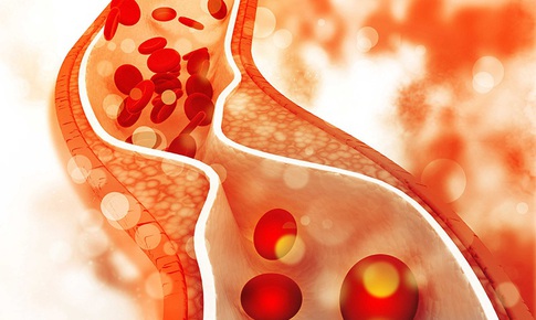 Tại sao chỉ số cholesterol vẫn cao dù ăn uống điều độ và tập thể dục thường xuyên?