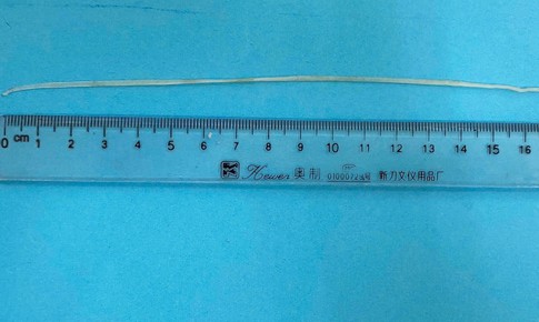 Tưởng chỉ là sưng tấy, bất ngờ bác sĩ rút được giun rồng dài gần 20 cm từ vết thương