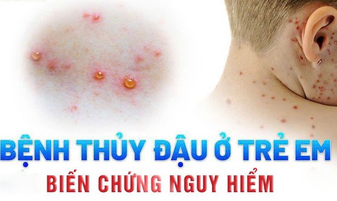 Cứu sống bé sơ sinh 15 ngày tuổi bị thủy đậu biến chứng ác tính