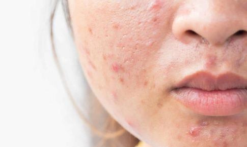Thực phẩm dễ gây mụn trứng cá