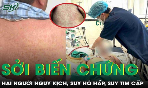 Hai bệnh nhân nguy kịch vì mắc sởi biến chứng viêm phổi nặng, suy tim cấp