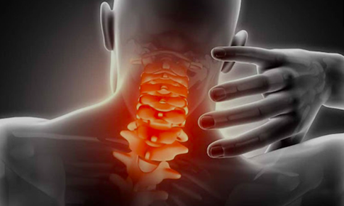 Đau cổ vai g&#225;y c&#243; thể bị liệt nếu điều trị sai c&#225;ch