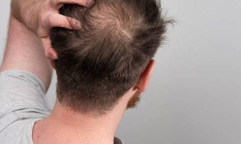 Dùng thuốc gây rụng tóc, chữa thế nào?