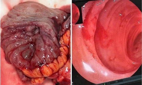 Người đàn ông suýt mất mạng do xuất huyết ruột non hiếm gặp