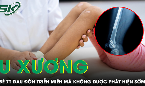 Khối u xương khiến b&#233; 7 tuổi đau triền mi&#234;n, dấu hiệu cha mẹ kh&#244;ng n&#234;n bỏ qua