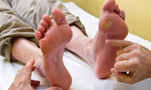 Tổn thương b&#224;n ch&#226;n ở người tiểu đường cần ph&#225;t hiện sớm