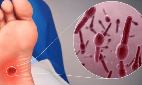 Chủ quan với vết thương nhỏ có thể mắc uốn ván nguy hiểm
