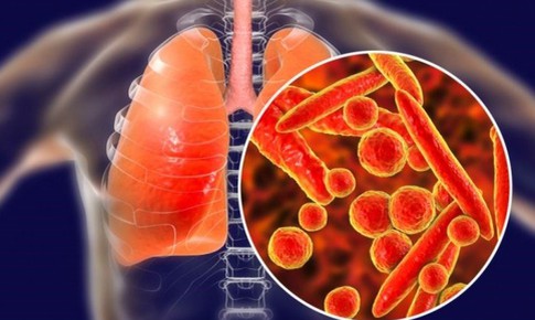 Những dấu hiệu cảnh báo sớm bệnh lao phổi bạn không nên bỏ qua