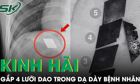 Kinh hãi nam thanh niên 26 tuổi nuốt trọn 4 lưỡi dao rọc giấy và 1 dao lam vào bụng