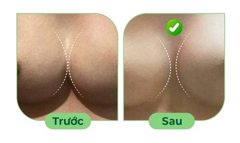 Điều trị ngực thông khe sau nâng ngực