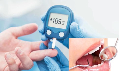 B&#237; quyết ngăn ngừa biến chứng răng miệng ở người bệnh tiểu đường