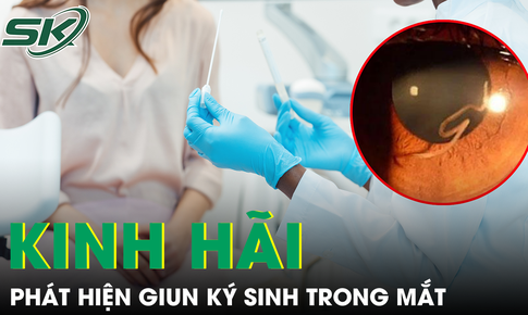 Mắt bị cộm, người phụ nữ tá hoả phát hiện giun dài 4cm ký sinh trong mắt