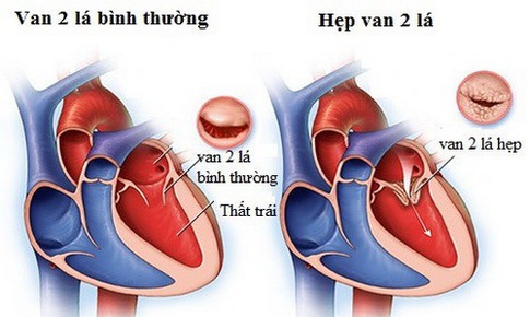 Kh&#243; thở cảnh gi&#225;c với bệnh hẹp van hai l&#225;