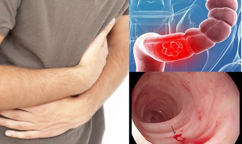 Phát hiện mắc ung thư sau 3 tháng rối loạn tiêu hóa