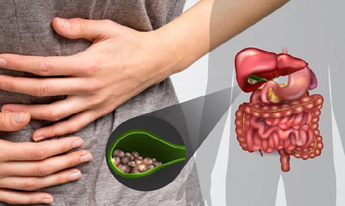 Sỏi mật gây biến chứng gì?