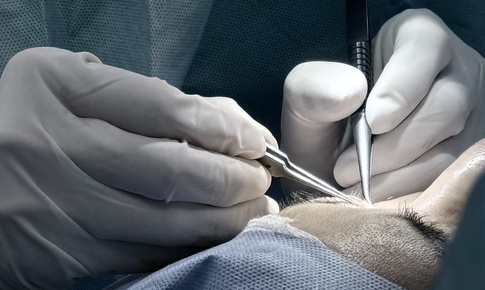Chuyên gia lý giải về điều trị cắt mí hỏng