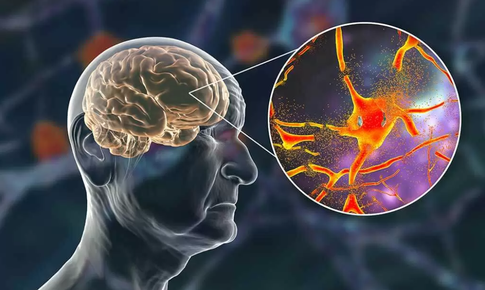 Cảnh báo trí nhớ suy giảm nhanh chóng nếu ăn nhiều thực phẩm này