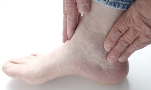 Biểu hiện biến chứng thận ở bệnh nh&#226;n tiểu đường