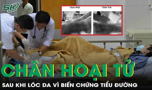 Chân hoại tử đen sì sau khi lóc da vì biến chứng tiểu đường