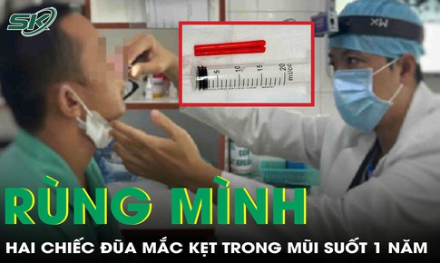 Rùng mình phát hiện 2 chiếc đũa mắc kẹt trong mũi người đàn ông sau hơn 1 năm té ngã
