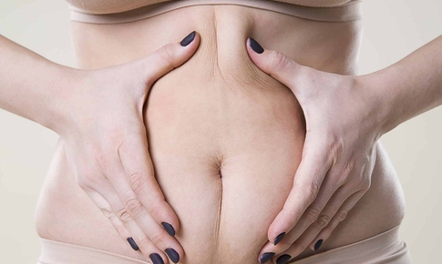Vì sao ăn ít vẫn có mỡ bụng?