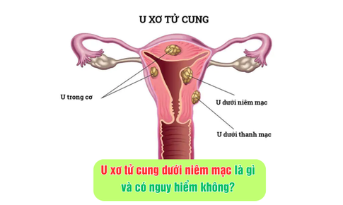 U xơ tử cung dưới niêm mạc là gì và ảnh hưởng sức khỏe thế nào?