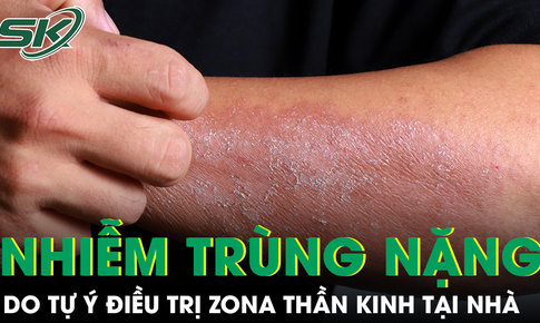 Tự chữa zona thần kinh, người đàn ông nhập viện vì nhiễm trùng nặng, vết thương chảy mủ