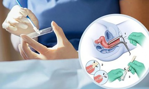 Cách tốt nhất để phát hiện sớm ung thư cổ tử cung