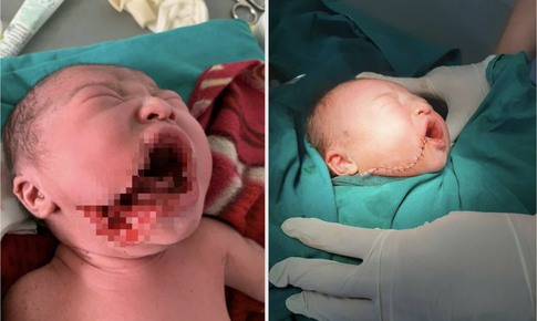Những nỗ lực chăm s&#243;c b&#224; mẹ, trẻ em ở Lũng C&#250; v&#224; c&#226;u chuyện lay động cứu sống b&#233; sơ sinh bị rạch một vết s&#226;u v&#224;o m&#225;