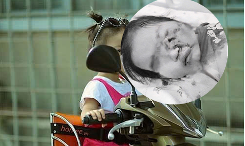 B&#233; 26 th&#225;ng tuổi chấn thương mắt, m&#244;i, dập phổi do rồ ga xe m&#225;y